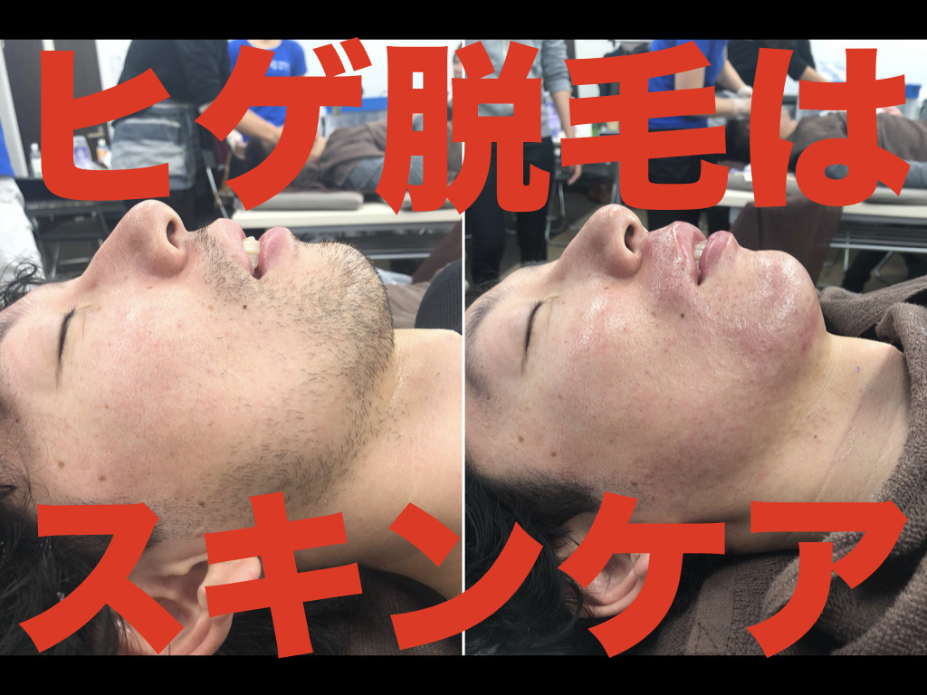 男性のヒゲ脱毛はスキンケア！